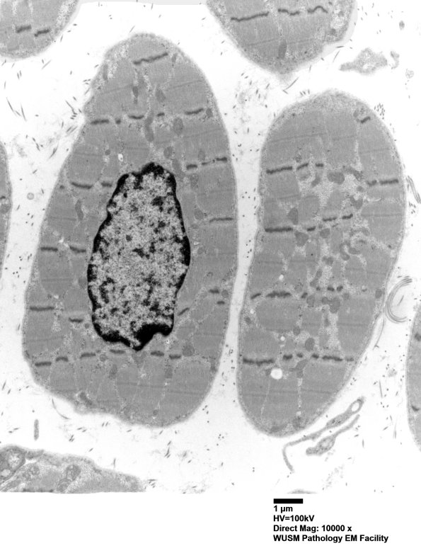 1C2B Centronuclear Myopathy (Case 1) EM 024 - Copy