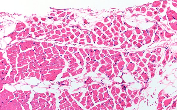 2A1 Centronuclear Myopathy (Case 2) H&E 20X