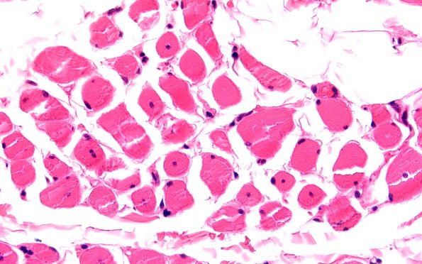 2A2 Centronuclear Myopathy (Case 2) H&E 60X