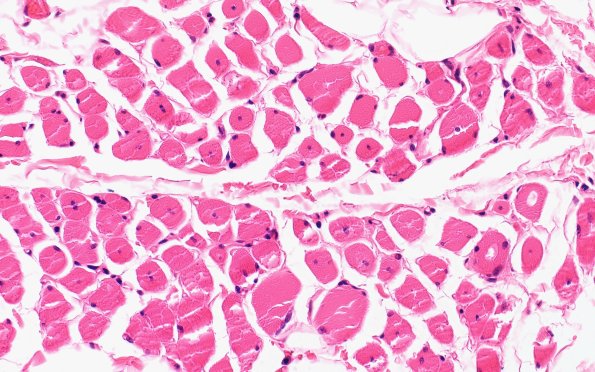 2A3 Centronuclear Myopathy (Case 2 H&E 400X