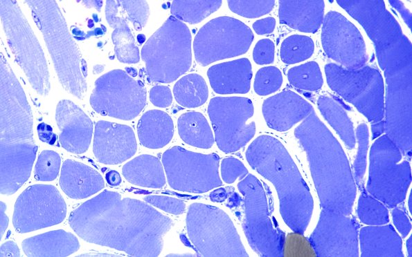 2B1 Centronuclear Myopathy (Case 2) Plastic 60X