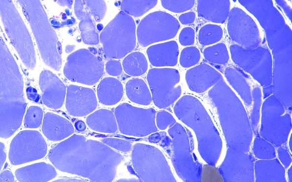 2B3A Centronuclear Myopathy (Case 2) Plastic 60X 2