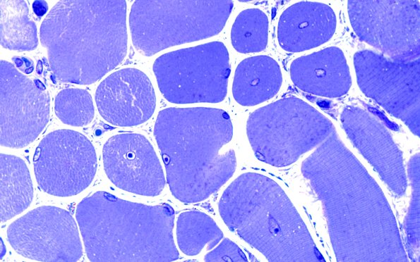 2B3B Centronuclear Myopathy (Case 2) Plastic 100X 2
