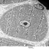 2C1 Case 2 Centronuclear Myopathy_EM017 - Copy