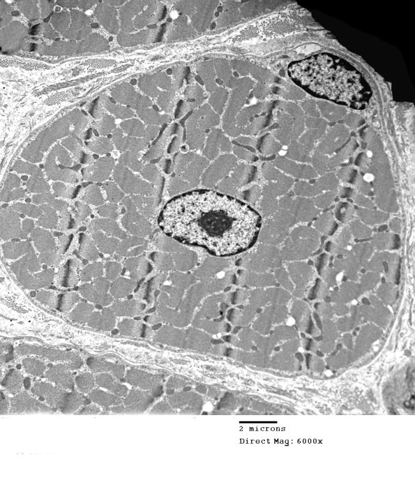 2C1 Case 2 Centronuclear Myopathy_EM017 - Copy