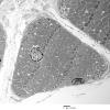 2C2 Case 2 Centronuclear Myopathy_EM012 - Copy