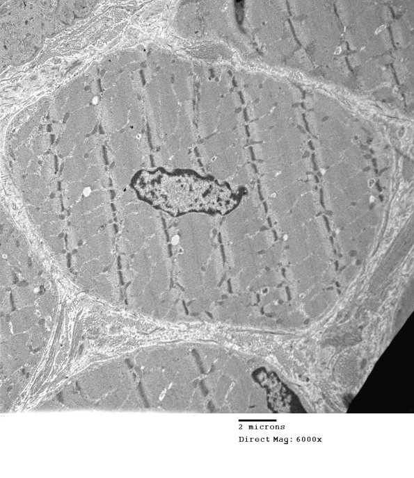 2C3 Case 2 Centronuclear Myopathy_EM014 - Copy