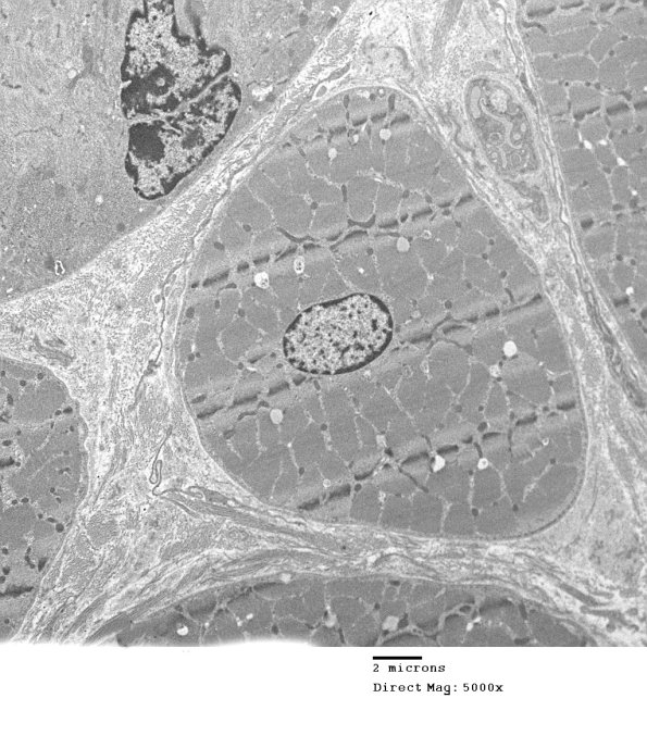 2C4 Case 2 Centronuclear Myopathy_EM023 - Copy