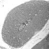 2C5A Case 2 Centronuclear Myopathy_EM018 - Copy