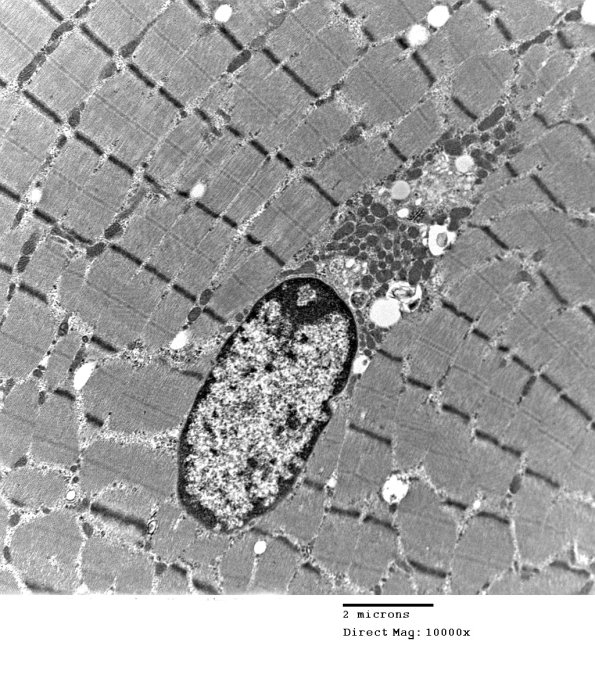 2C5B Case 2 Centronuclear Myopathy_EM019 - Copy