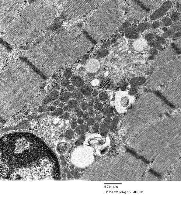 2C5C Case 2 Centronuclear Myopathy_EM021 - Copy