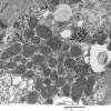 2C5D Case 2 Centronuclear Myopathy_EM022 - Copy