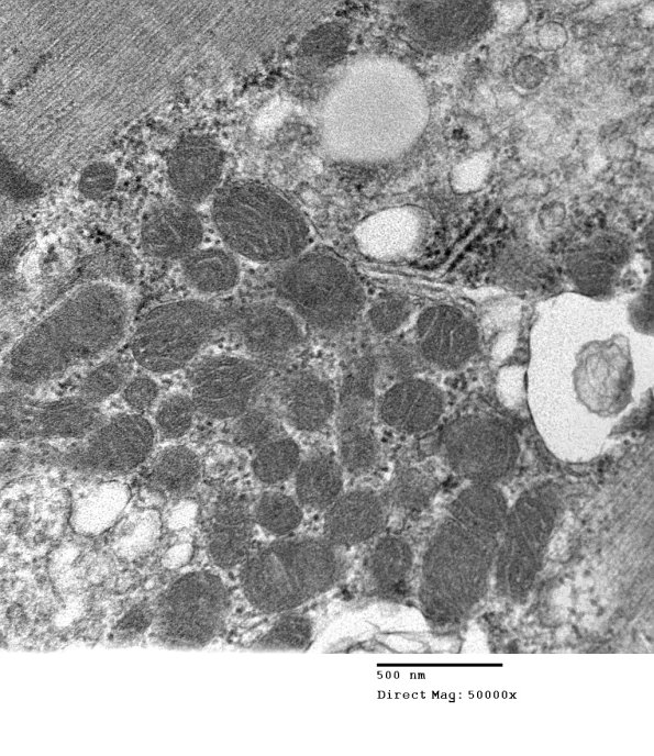 2C5D Case 2 Centronuclear Myopathy_EM022 - Copy