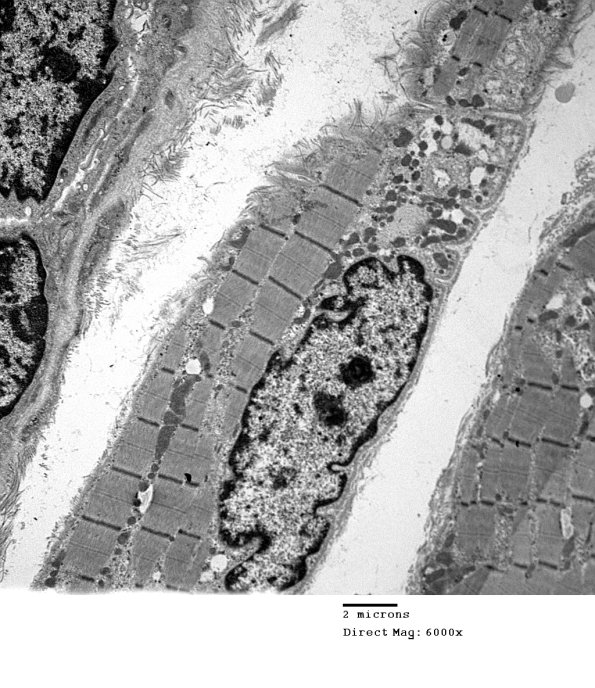 2C6A Case 2 Centronuclear Myopathy_EM010 - Copy