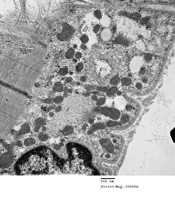 2C6B Case 2 Centronuclear Myopathy_EM011 - Copy
