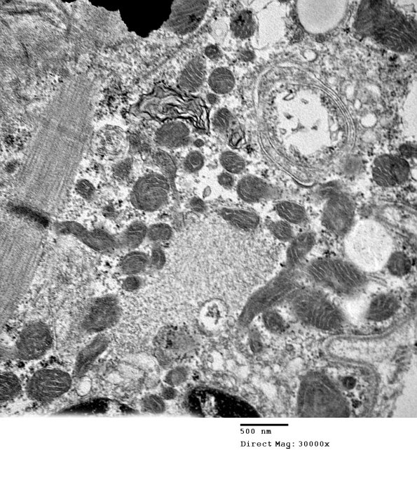 2C6C Case 2 Centronuclear Myopathy_EM003 - Copy