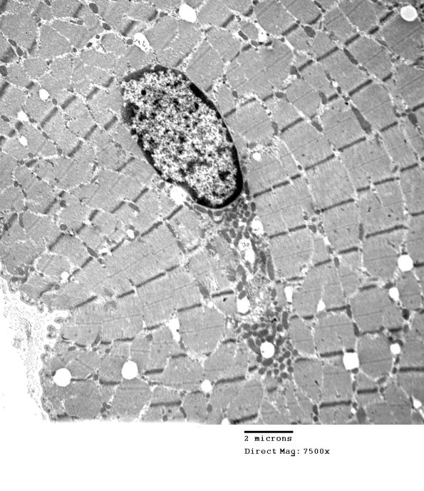 2C7A Case 2 Centronuclear Myopathy_EM006 - Copy