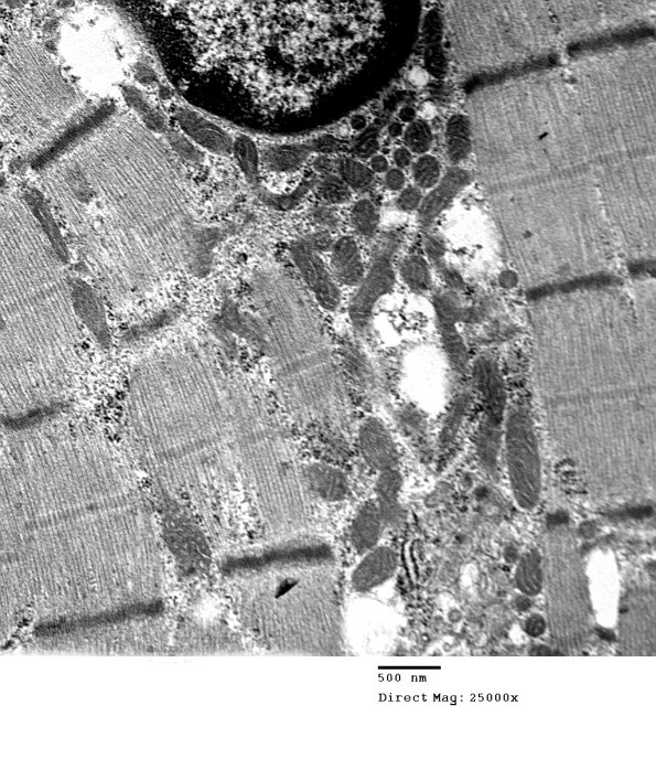 2C7B Case 2 Centronuclear Myopathy_EM007 - Copy