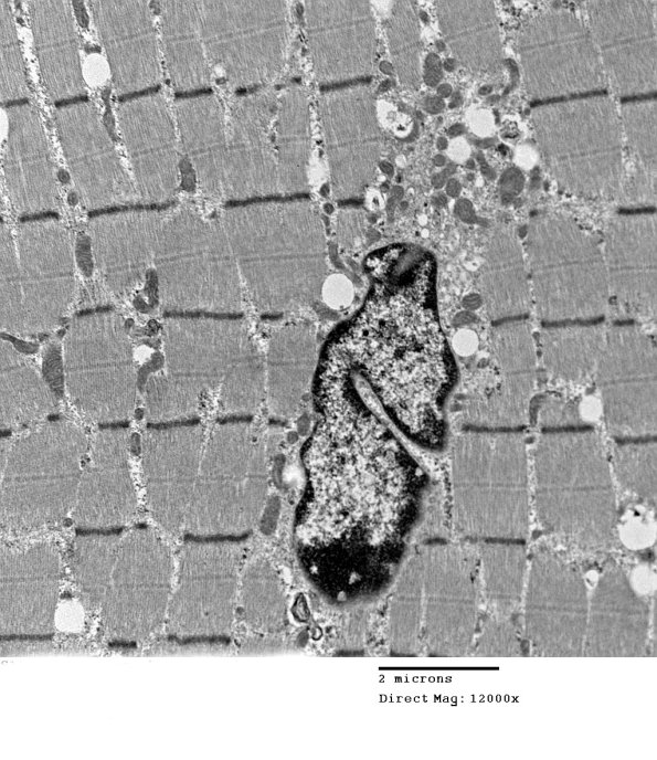 2C8 Case 2 Centronuclear Myopathy_EM004 - Copy