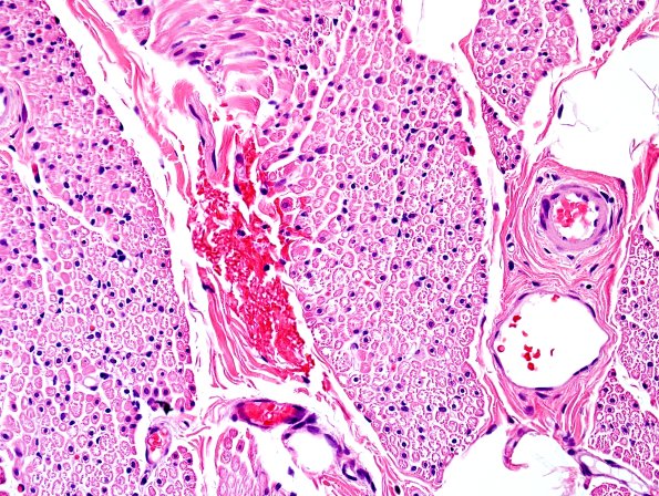 3A1-Centronuclear-Myopathy-Case-3-H-E-1.jpg
