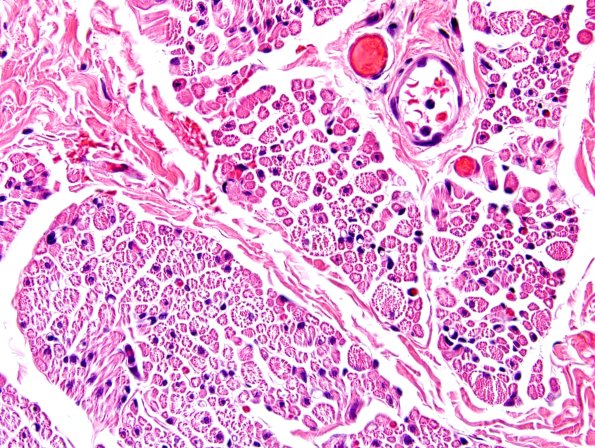3A2-Centronuclear-Myopathy-Case-3-H-E-3.jpg