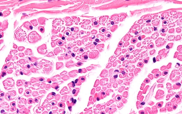 3A4 Centronuclear Myopathy (Case 3 H&E 100X 1