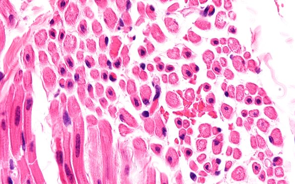 3A6 Centronuclear Myopathy (Case 3) H&E 100X 3