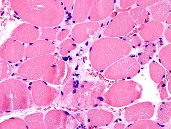 1A1-Cystinosis-muscle-Case-1-H-E-3.jpg