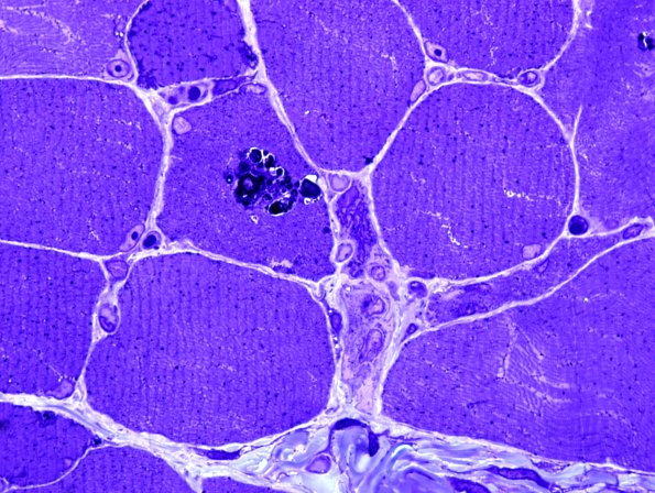 1B2-Cystinosis-muscle-Case-1-Plastic-5.jpg