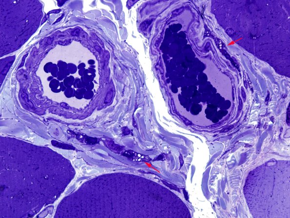 1B3-Cystinosis-muscle-Case-1-Plastic-4-copy.jpg