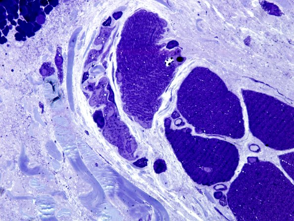 1B4-Cystinosis-muscle-Case-1-Plastic-6.jpg