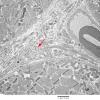 1C1 Cystinosis (Case 1) EM047 copy - Copy