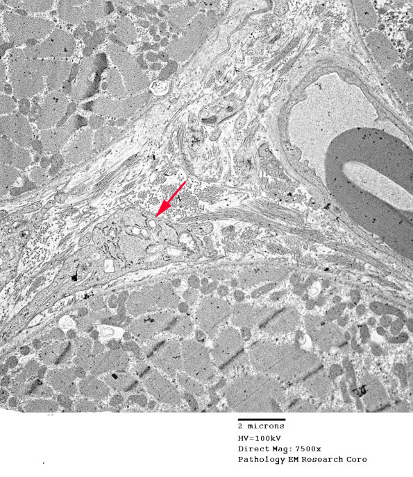 1C1 Cystinosis (Case 1) EM047 copy - Copy