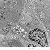 1C2A Cystinosis (Case 1) EM032 - Copy