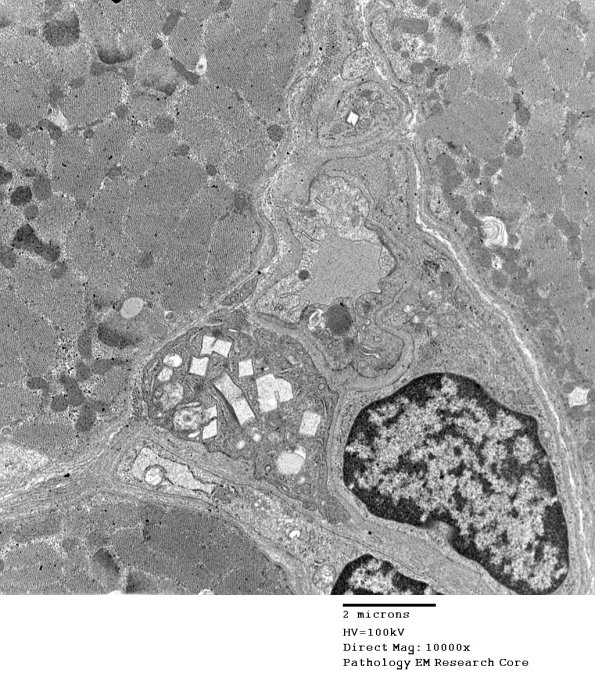 1C2A Cystinosis (Case 1) EM032 - Copy