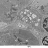 1C2B Cystinosis (Case 1) EM027 - Copy