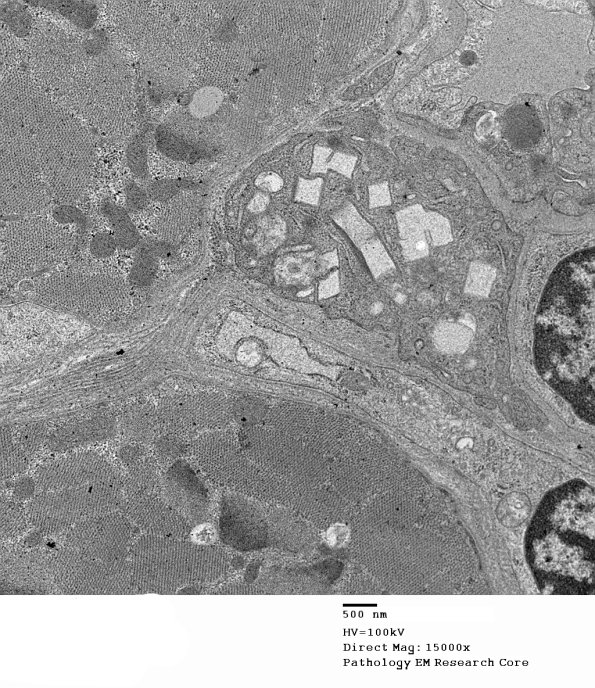 1C2B Cystinosis (Case 1) EM027 - Copy
