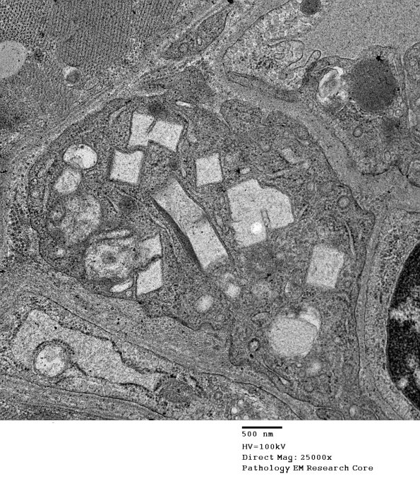 1C2C Cystinosis (Case 1) EM028 - Copy