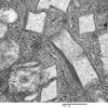 1C2D Cystinosis (Case 1) EM030 - Copy