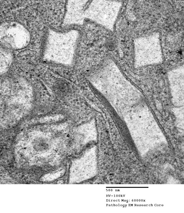 1C2D Cystinosis (Case 1) EM030 - Copy