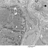 1C3A Cystinosis (Case 1) EM033 - Copy