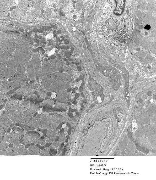 1C3A Cystinosis (Case 1) EM033 - Copy