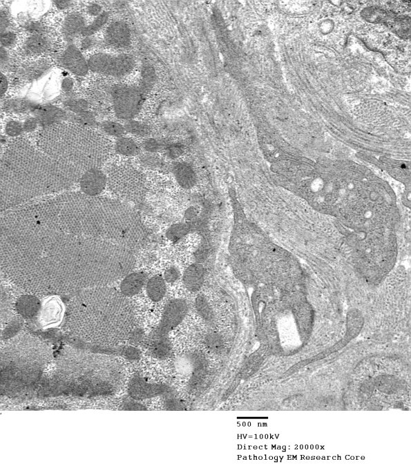 1C3B Cystinosis (Case 1) EM034 - Copy