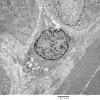 1C4A Cystinosis (Case 1) EM035 - Copy