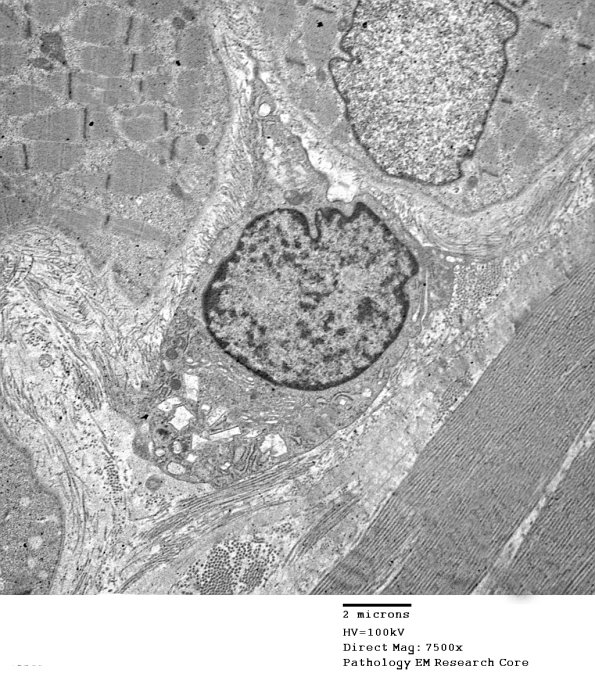 1C4A Cystinosis (Case 1) EM035 - Copy