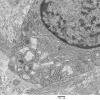 1C4B Cystinosis (Case 1) EM036 - Copy