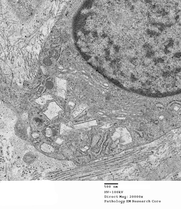 1C4B Cystinosis (Case 1) EM036 - Copy