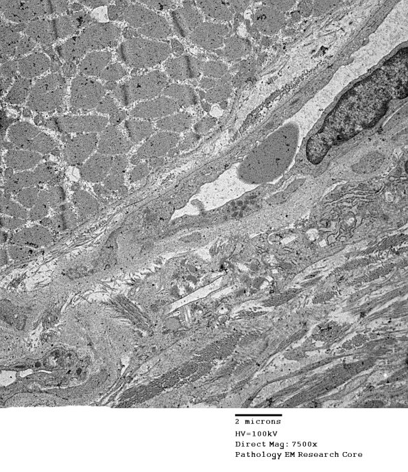 1C5A Cystinosis (Case 1) EM042 - Copy