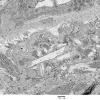 1C5B-Cystinosis-Case-1-EM043-Copy.jpg