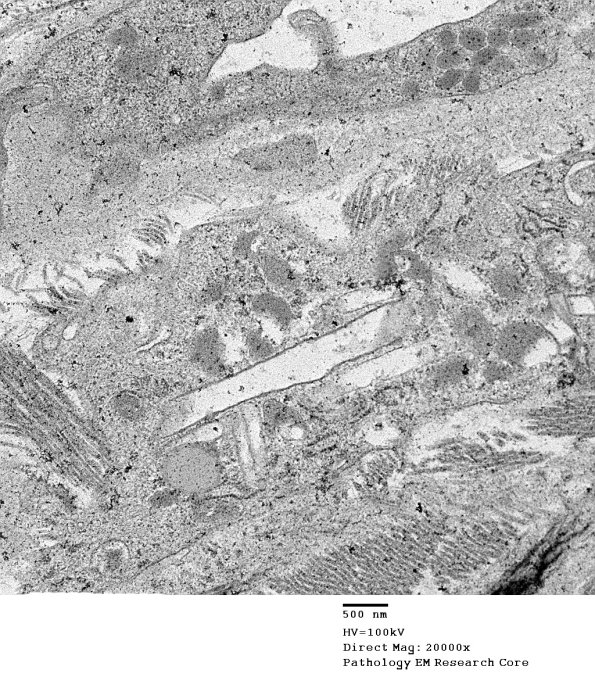 1C5B-Cystinosis-Case-1-EM043-Copy.jpg